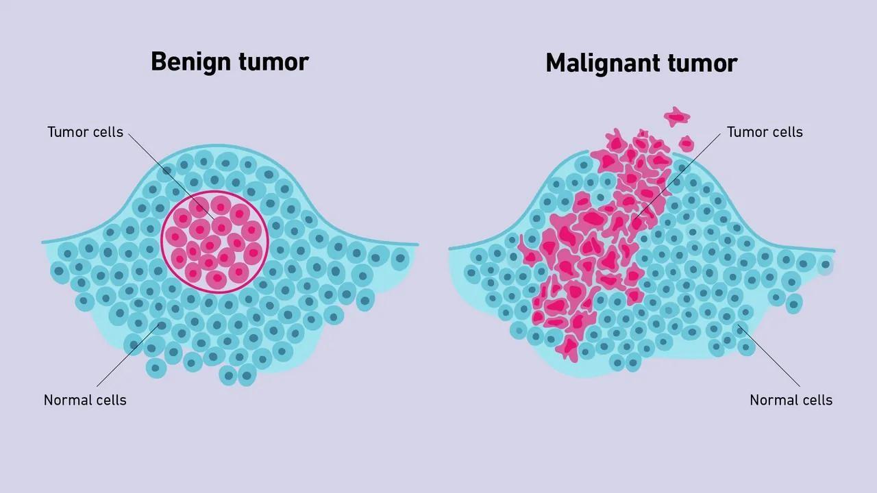 brest tumor Fivebrane